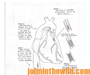Illustration of John's stent
