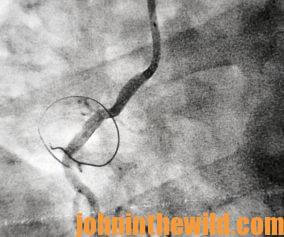 Imaging of the blockage and stent location