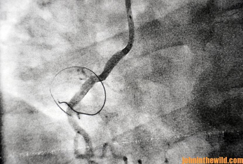 Imaging of the blockage and stent location